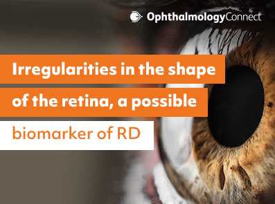 Irregularities in Retinal Shape