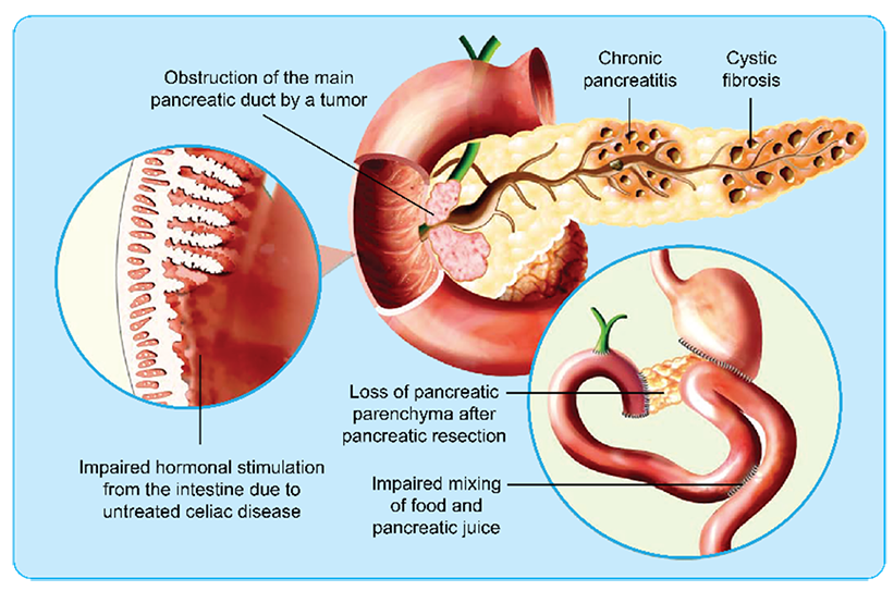  athology of pancreatic exocrine insufficiency