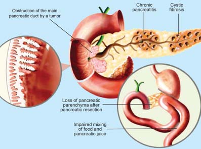 læge som holder en pankreas