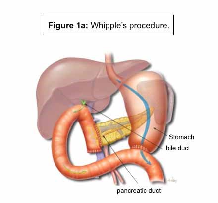 Whippe procedure og EPI