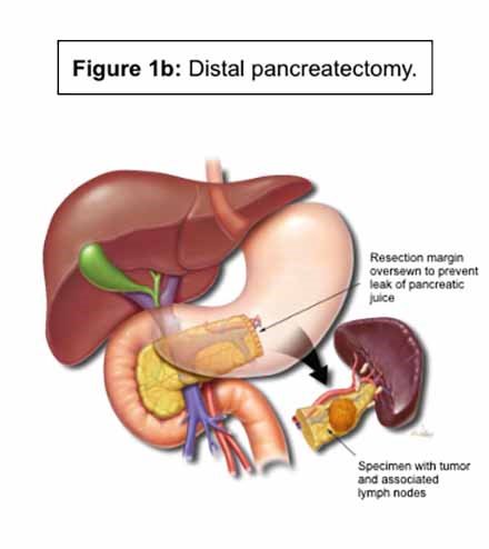 Distal pancreatectomy