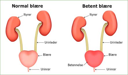 Normal blære og betent blære